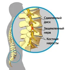 Ишиас - какво е това, симптоми, причини, оказване на първа помощ