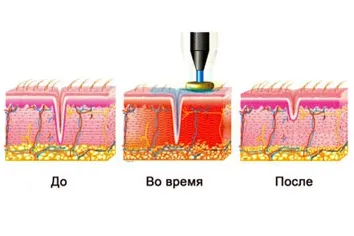 Rf повдигане действие, показания, противопоказания, резултатите
