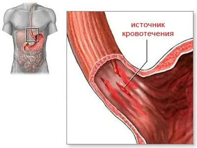 Повръщане на кръв - какво да правя, като причините за спиране на лечението (лечение) Повръщане на кръв - какво да правя, като причините за спиране на лечението