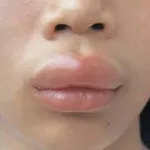 Белене на кожата на дланите на причините, лечение, снимката