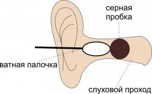 Ушна кал в симптомите ухото, е възможно да се премахне като у дома си, здравето азбука (корк) Ушна кал в симптомите на ухо, е възможно да се премахне като у дома си, ABC Здраве