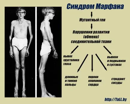 Синдром на Марфан - описание на болестта, лечението, снимки