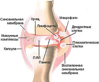 Възстановяване на хрущяла на ставите пакет от мерки в коляното да се лекува