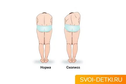 Сколиоза при деца причинява и превенция
