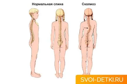 Сколиоза при деца причинява и превенция