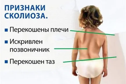 Сколиоза при деца причинява, лечение и профилактика