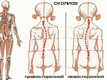 Сколиоза при деца причинява, признаци, симптоми, лечение
