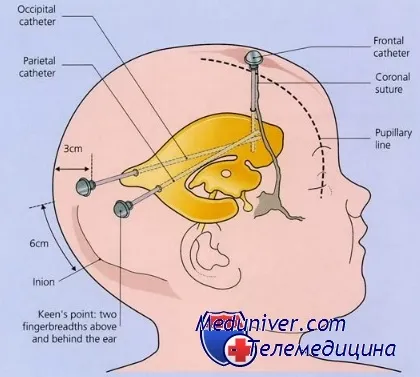 Техника ventriculoperitoneal маневрена хидроцефалия