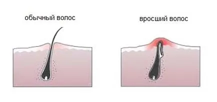 Врастнали за третиране на коса, прогноза, симптоми, диагностика, каузи
