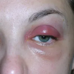 Горния клепач Chalazion лечение на народната медицина у дома