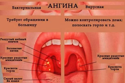 Има болки в гърлото е заразен с другите гноен (фоликуларна), бактериални, вирусни
