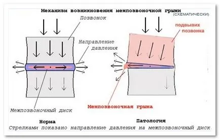 Лечение междупрешленните херния без операция
