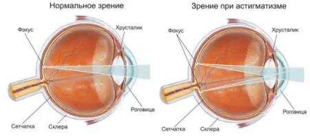 Астигматизмът при децата какво е