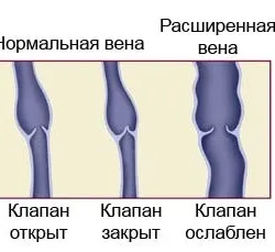 Как да се премахнат болка в краката