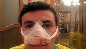 Какво да правим, когато е със счупен нос Какво да правим, когато е със счупен нос