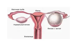 Защо се образуват кисти