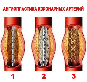 Стентиране след сърдечен удар