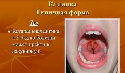 Как бързо да се отървете от възпалено гърло
