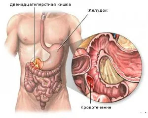 Схемата на лечение на стомашни язви