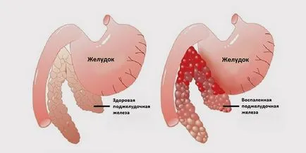 Какво е панкреатит панкреаса Какво е панкреатит панкреаса