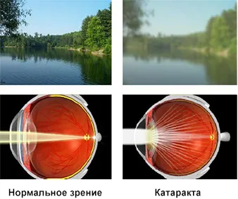 лечение на обектива лечение на обектива