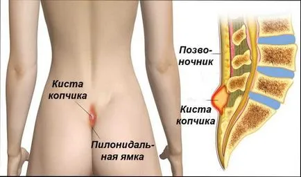 Защото от това, което опашната кост киста