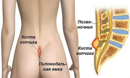 Защото от това, което опашната кост киста Защото от това, което опашната кост киста