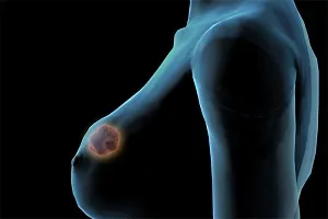 лечение Fibroadenomatosis гърдата