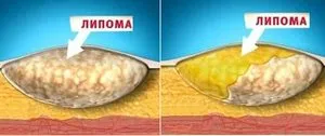 Бучката на врата му от това, което