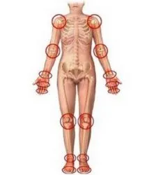 лечение polyosteoarthrosis