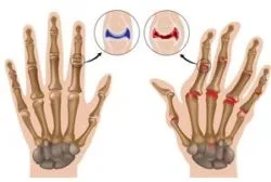 лечение polyosteoarthrosis