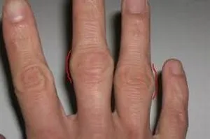 лечение polyosteoarthrosis лечение polyosteoarthrosis