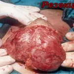 лечение Fibroadenomatosis гърдата лечение Fibroadenomatosis гърдата
