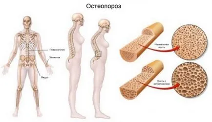 Лекарство за лечение на остеопороза Лекарство за лечение на остеопороза