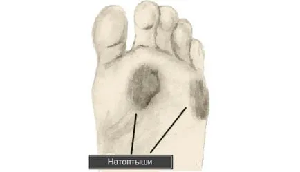 Пъпки по лечението на крака народни средства Пъпки по лечението на крака народни средства