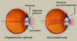 Астигматизмът при децата какво е