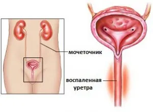 Уретрално го освободи