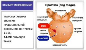 подготовка Uzi простатата подготовка Uzi простатата