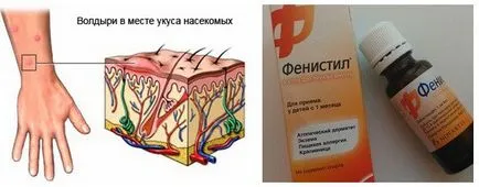 Алергия към ухапване от комари при децата снимка, симптоми, лечение