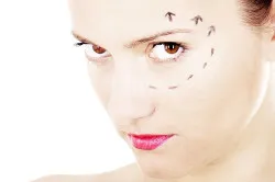 Blepharoplasty горния клепач период на възстановяване (горната) Blepharoplasty възстановителен период горния клепач