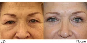 Blepharoplasty на горната подготовка клепачи в продължение на операция, периода на рехабилитация