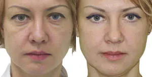 Blepharoplasty на горната подготовка клепачи в продължение на операция, периода на рехабилитация