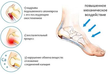 Хърт ходилата причините, какво да правят и как да се лекуват, ефективни народни средства за защита (фута) Хърт ходилата причините, какво да правят и как да се лекуват, ефективни народни средства
