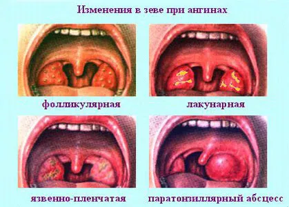 Ангина лечение у дома бързо - как да се отнасяме ангина народни средства за защита (бързо) Ангина лечение у дома бързо - как да се отнасяме ангина народни средства