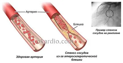 Ангиопластика индикации, подготовка, как процедурата, рисковете