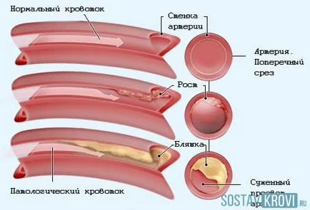 Балонна ангиопластика, коронарните, сърцето, кръвоносните съдове, долни крайници