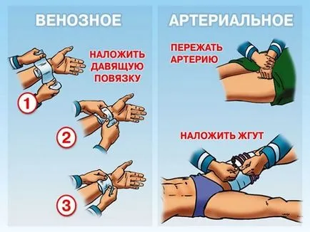 Артериална кървене симптоми и оказване на първа помощ, как да се спре кървенето