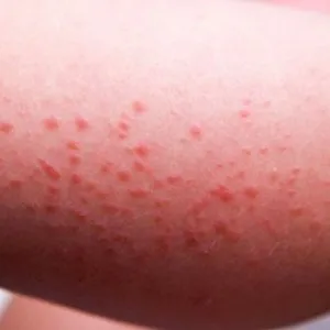 Краста симптоми, снимка, ранни признаци при възрастни, методи на лечение