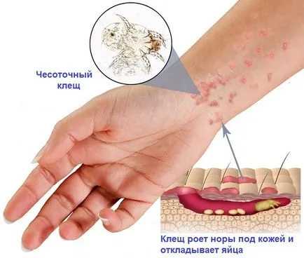 Краста симптоми, снимка, ранни признаци при възрастни, методи на лечение