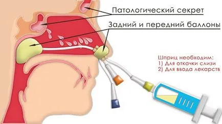 Какво е синузит и как да се лекува